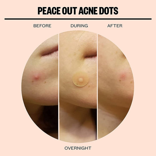 Acne Dots Hydrocolloid Anti-Acne Pimple Patches with Salicylic Acid and Vitamin A to Quickly Clear Blemishes - 20 dots