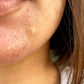 Acne Dots Hydrocolloid Anti-Acne Pimple Patches with Salicylic Acid and Vitamin A to Quickly Clear Blemishes - 20 dots
